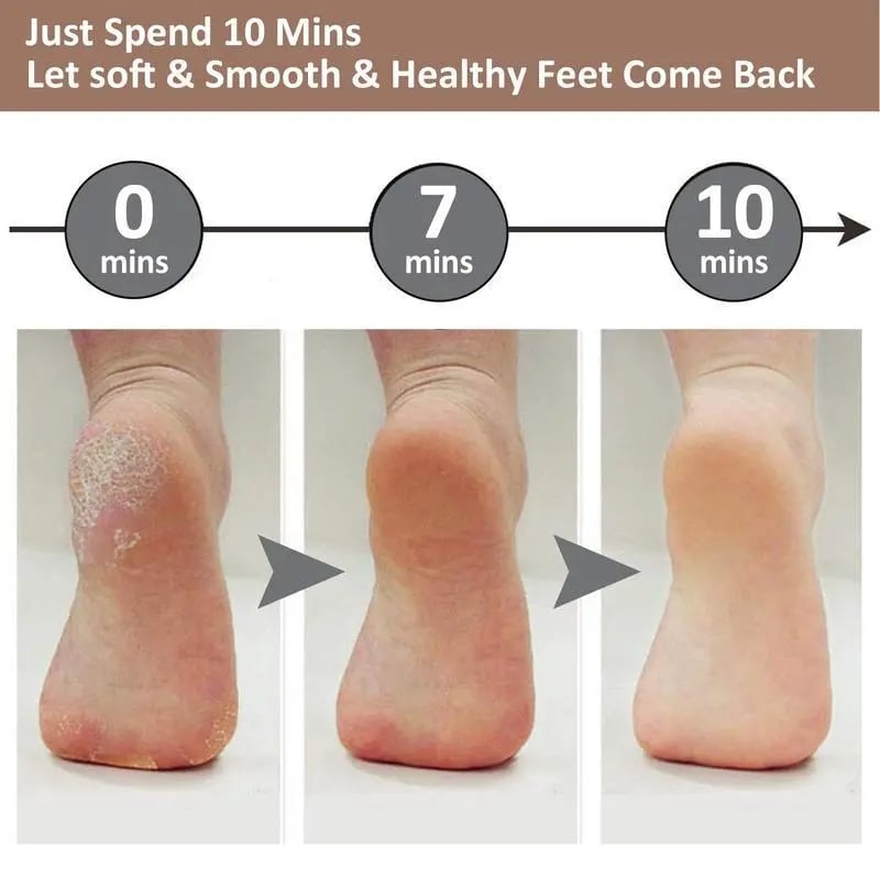 Electric Feet Callus Remover