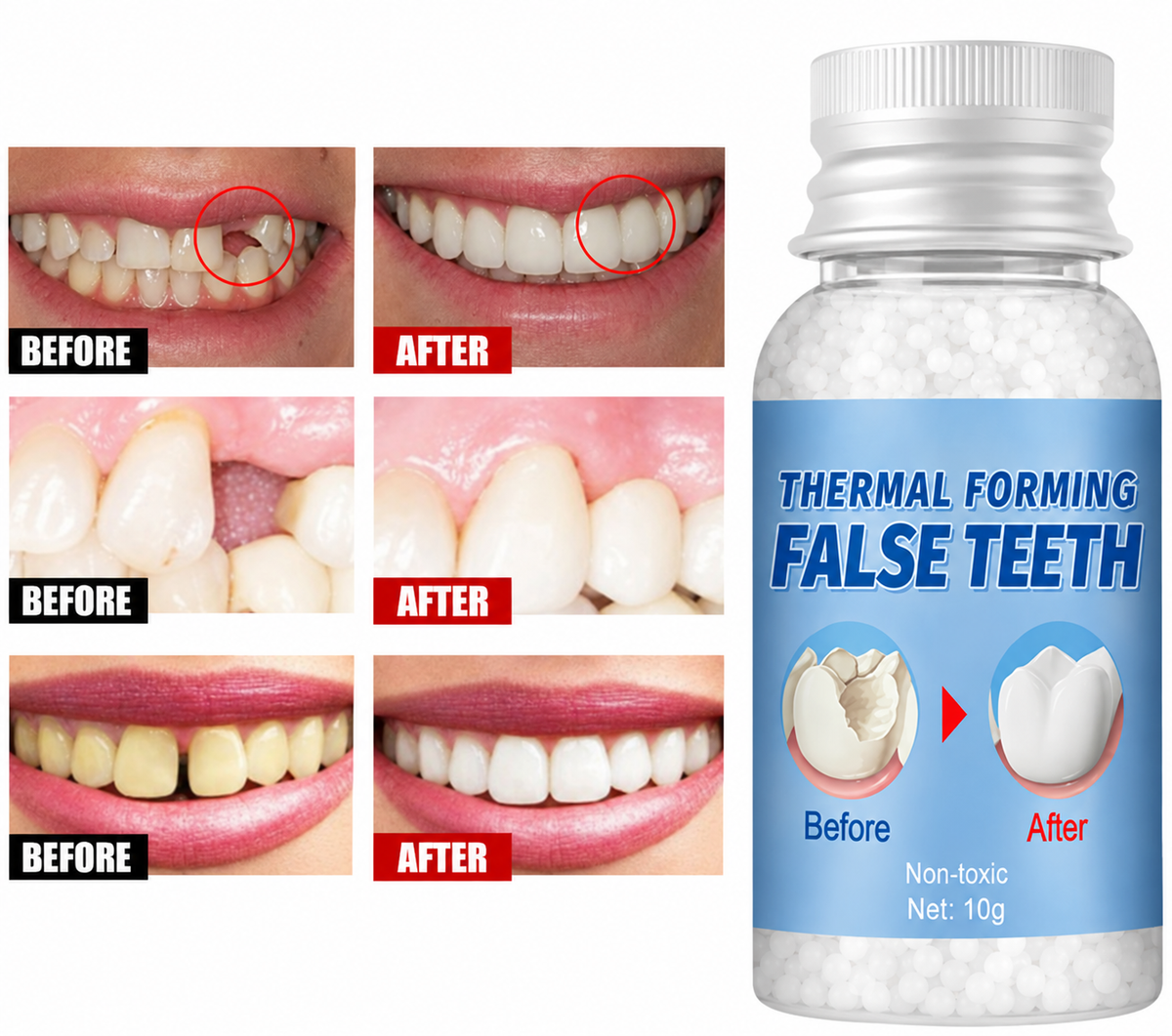 Hot melt adhesive denture beads for temporary restoration of missing or broken teeth | Filling alternatives